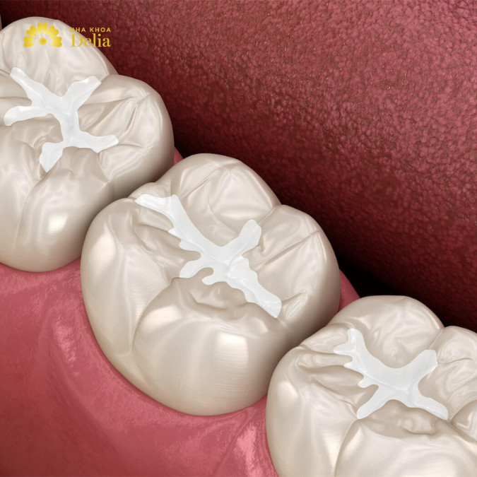 Răng sâu đen xì phải làm sao: Trám răng