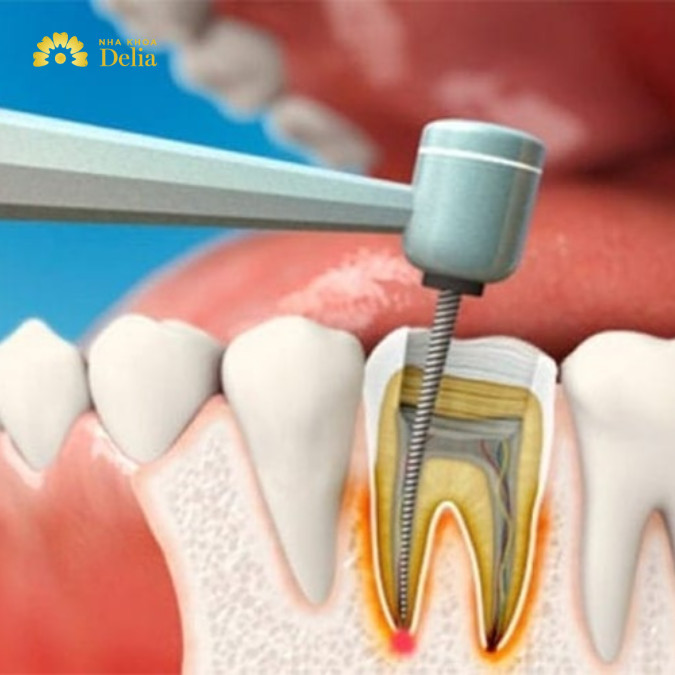 Răng số 5 hàm trên bị sâu cần làm gì: Điều trị tủy răng
