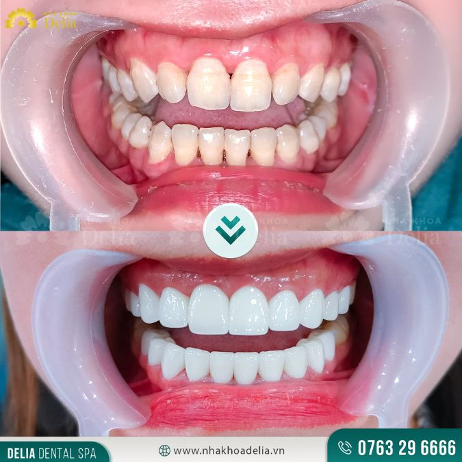 Răng có độ dài và kích cỡ vừa phải so với những răng còn lại chênh lệch không nhiều là răng thỏ đẹp