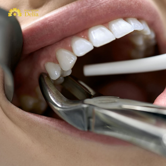 Điều trị sâu răng chảy máu tại nha khoa: nhổ răng