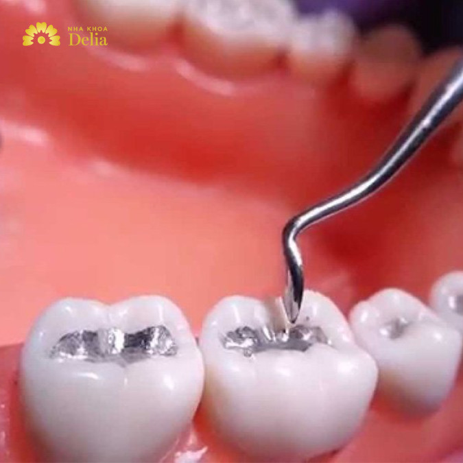 Điều trị sâu răng chảy máu tại nha khoa: trám răng