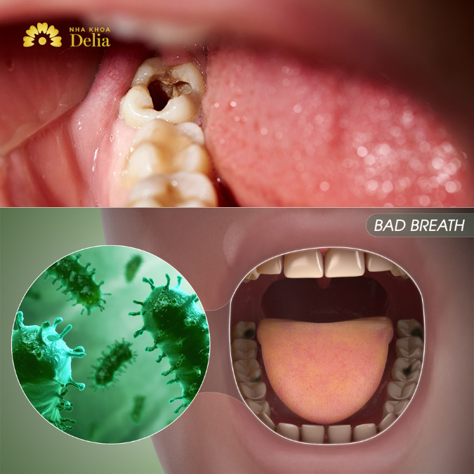 Sâu răng gây hôi miệng điều trị dứt điểm như thế nào?