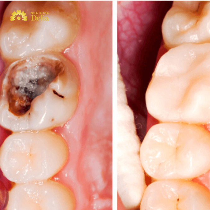 Cách điều trị sâu răng gây hôi miệng tại nha khoa: trám răng