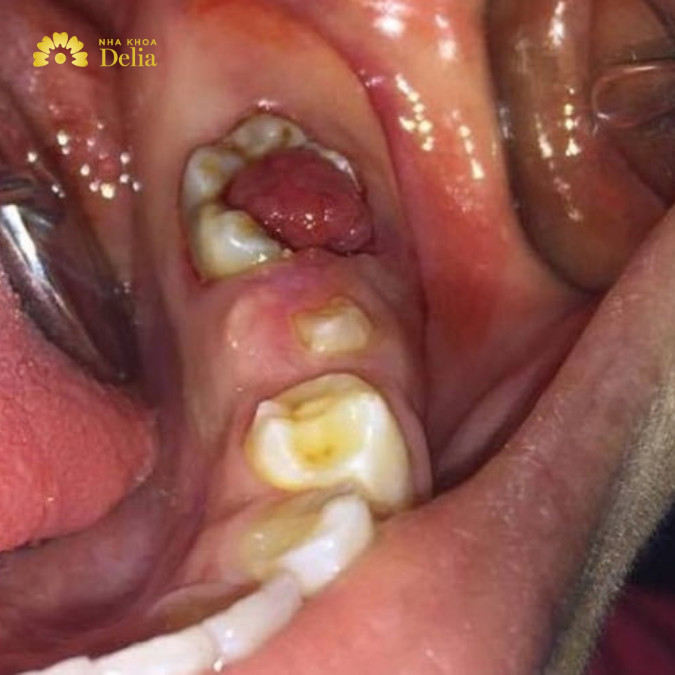 Hình ảnh sâu răng lồi thịt tình trạng nặng
