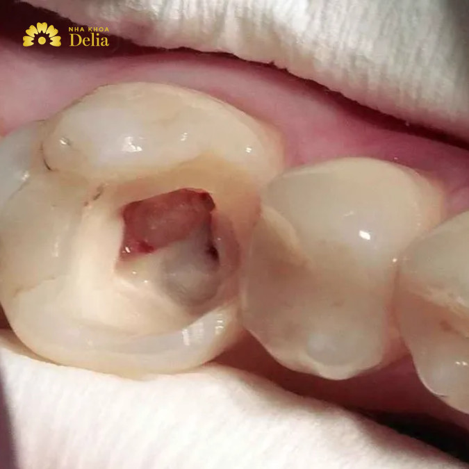 Giai đoạn 3: Hình thành polyp