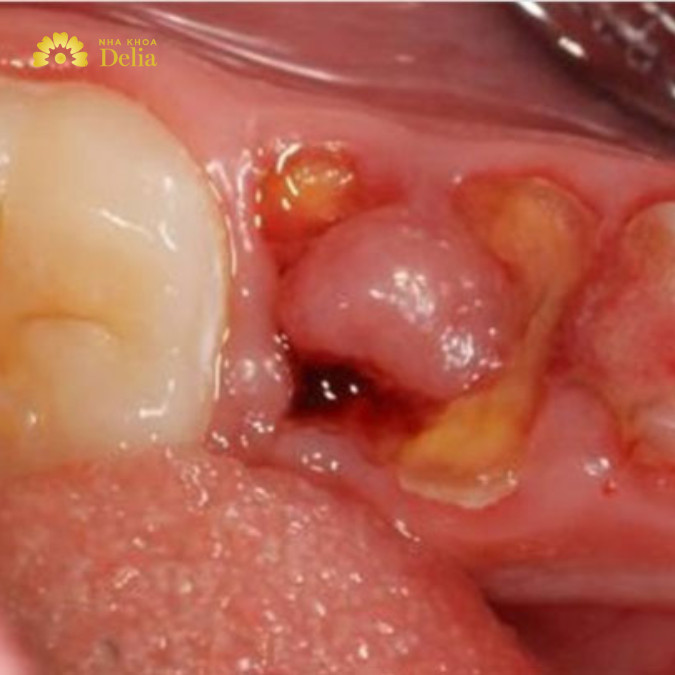 Giai đoạn 4: Biến chứng từ polyp răng