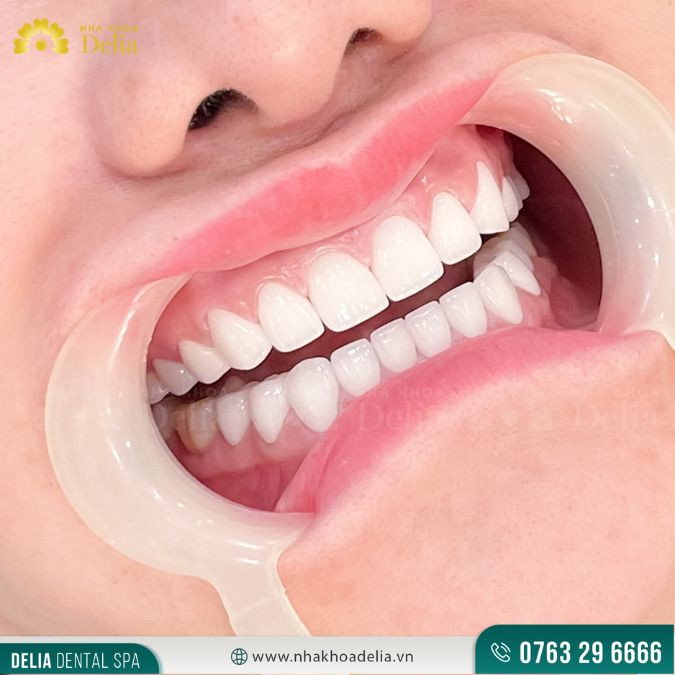 Sứ Orodent