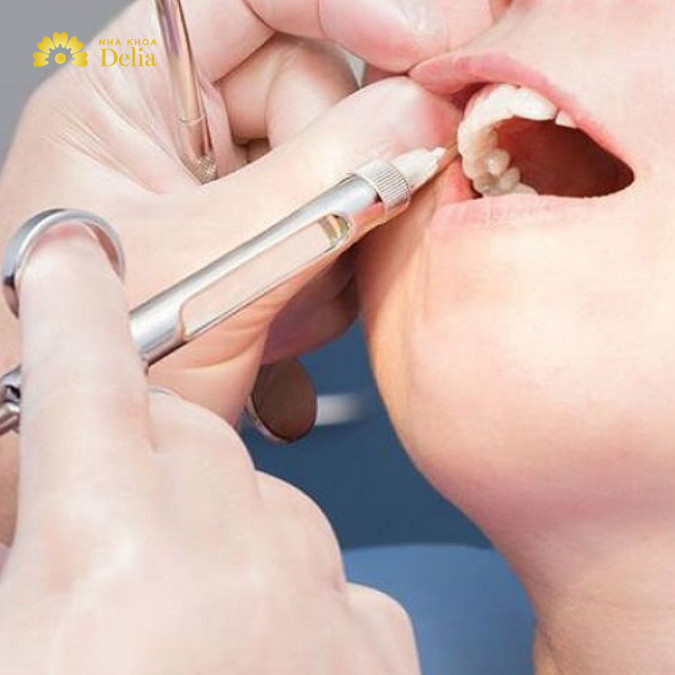 Thuốc tê nhổ răng có tác dụng trong bao lâu?