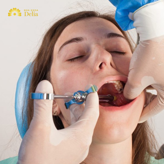 Tiêm thuốc tê nhổ răng có đau không?
