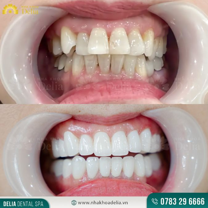 Tướng người răng hô