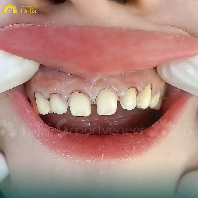 Tướng người răng không đều