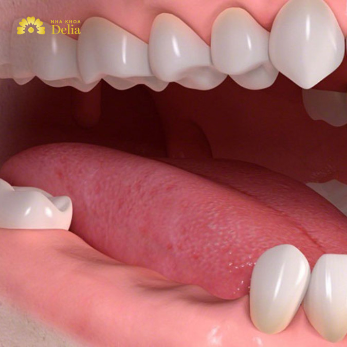 Khi tủy răng bị hoại tử lâu ngày dẫn đến mất răng vĩnh viễn