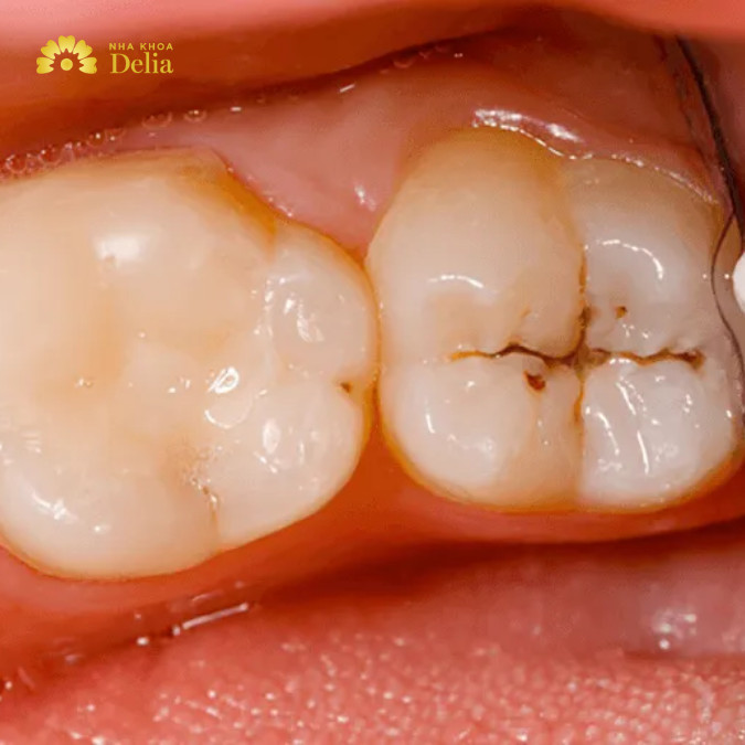 Sâu răng nhẹ không được điều trị kịp thời dẫn đến tình trạng nặng hơn, sâu đến tủy