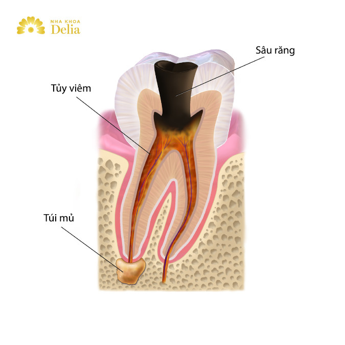 Viêm tủy răng có chữa được không, giải đáp từ A - Z