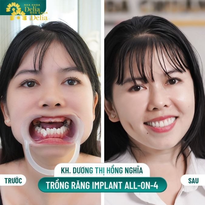 2 tuần trồng răng Implant lấy lại khả năng ăn nhai sau 22 năm mất răng - KH Dương Thị Hồng Nghĩa