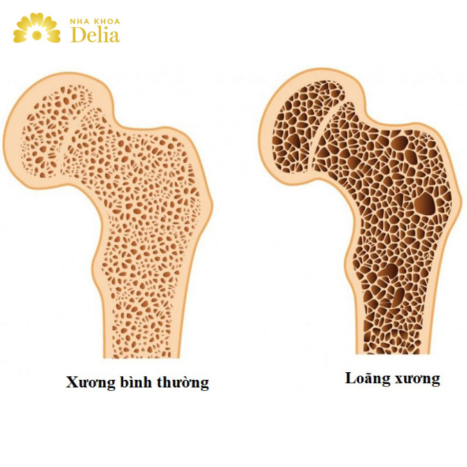 Thiếu Vitamin C gây loãng xương 