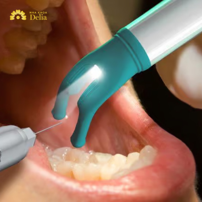 Thuốc tê nhổ răng được coi là an toàn cho mẹ bầu và thai nhi khi được dùng với liều lượng phù hợp