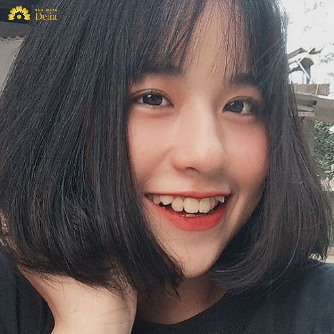 nếu như nhổ răng nanh sữa muộn hơn thông thường thì răng khểnh sẽ mọc tự nhiên