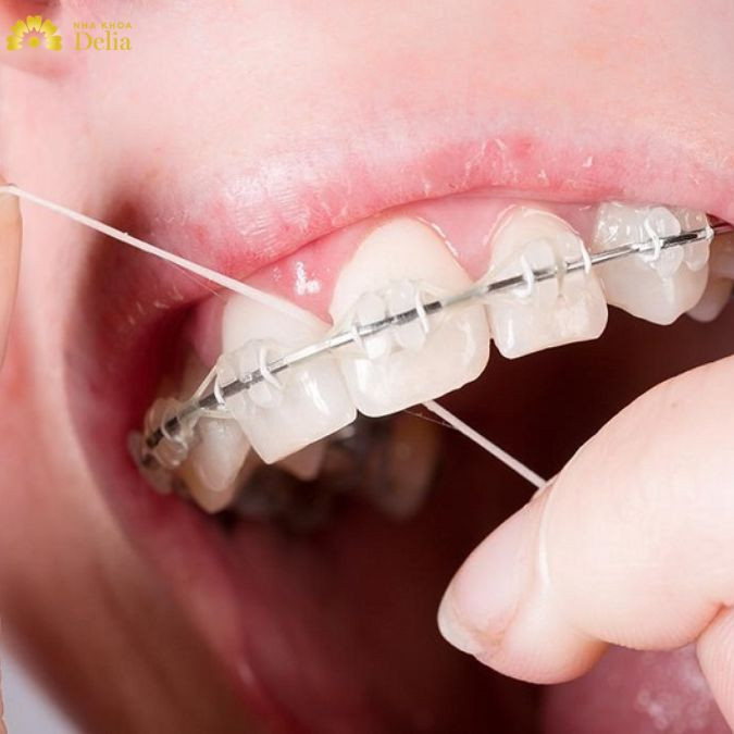 Cách sử dụng chỉ nha khoa với người niềng răng