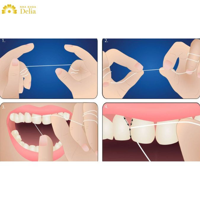 Việc tiết kiệm chỉ nha khoa quá mức vừa không thể làm sạch vụn thức ăn