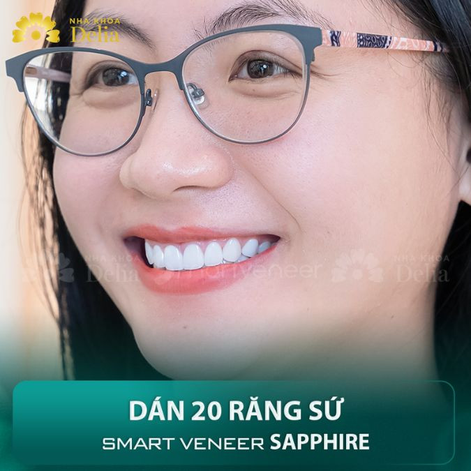 Dán sứ Veneer