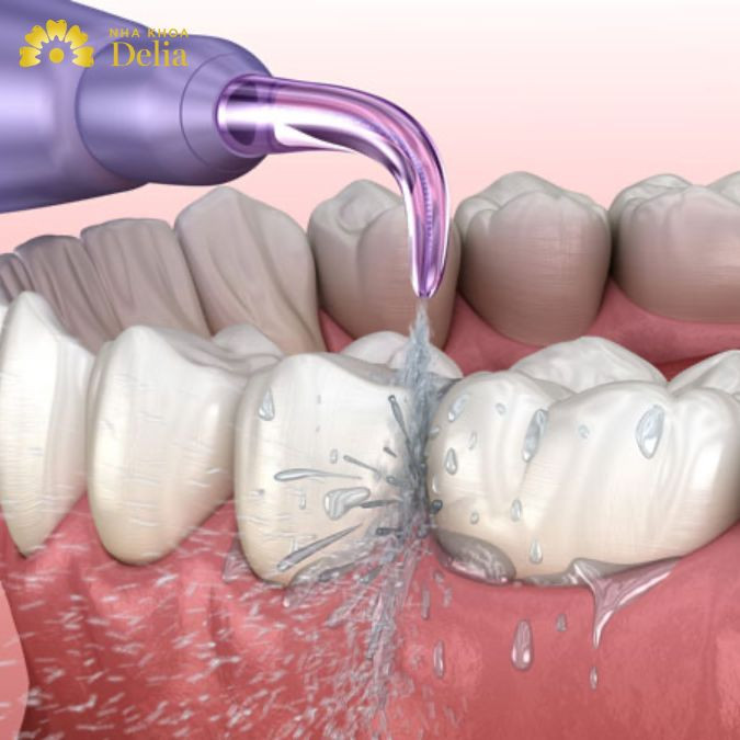 Dùng tăm nước sai cách ảnh hưởng tới sức khỏe răng miệng