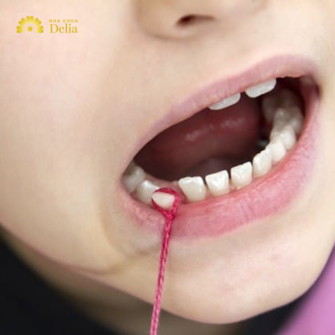 Cách nhổ răng hàm bị sâu tại nhà an toàn và nhanh chóng