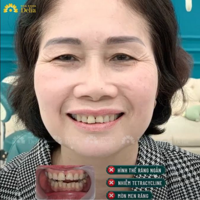 Răng xuống cấp khiến cô Mai mặc cảm và tự ti