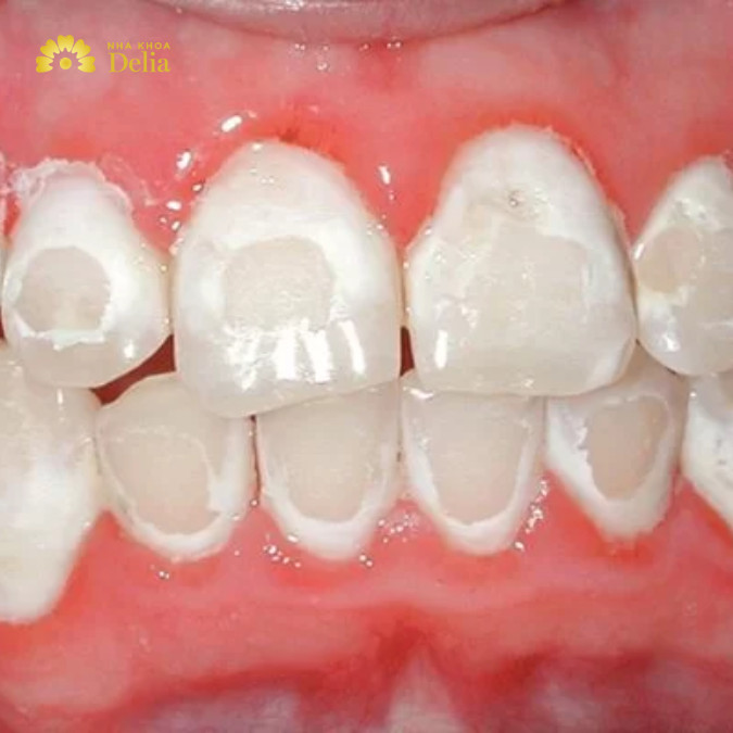 Sâu men răng là giai đoạn đầu của sâu răng, có thể điều trị bằng cách tái khoáng