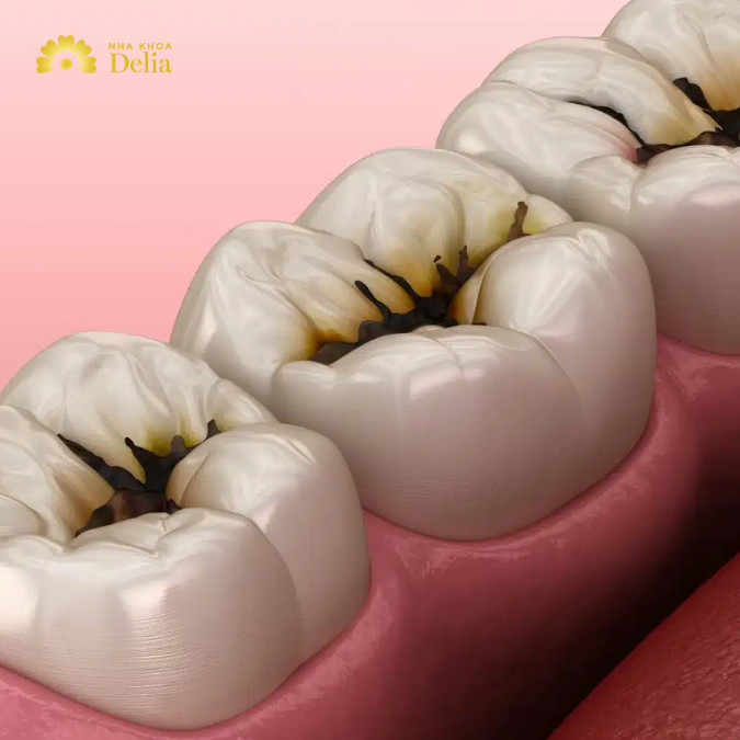 Sâu ngà răng là tình trạng sâu răng nặng hơn, bắt đầu xuất hiện các lỗ sâu đen hoặc nâu