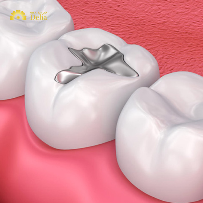 Răng sâu mức độ nhẹ nên hàn trám hoặc bọc sứ, nên bảo tồn bằng mọi cách có thể