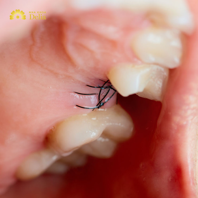 Răng sâu không nhổ có thể gây viêm nhiễm, đau đớn, ảnh hưởng chức năng ăn nhai
