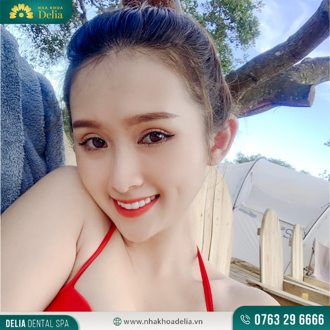 Hầu hết mọi người sẽ có tổng 32 răng vĩnh viễn, bao gồm cả 4 răng khôn