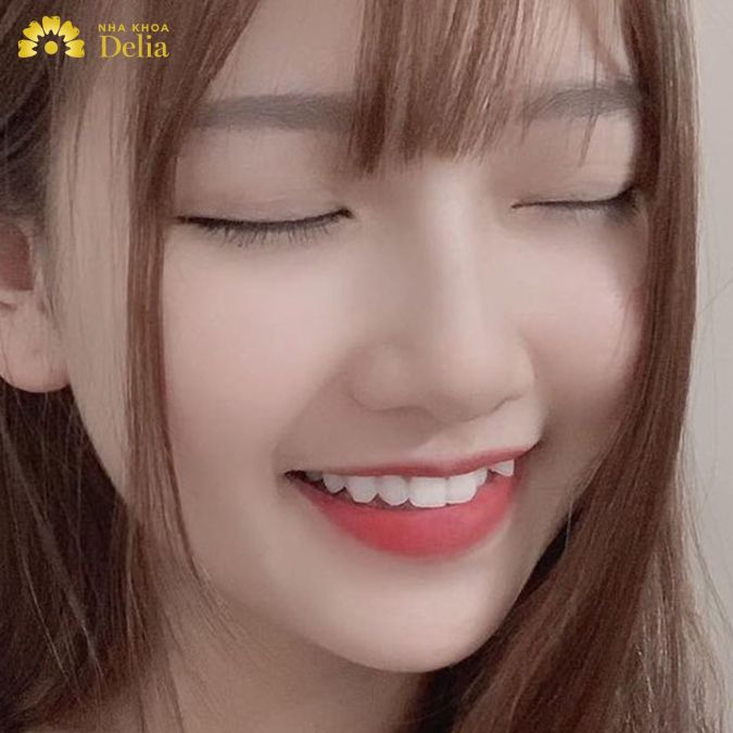 răng khểnh được xem là một nét đẹp thể hiện sự duyên dáng