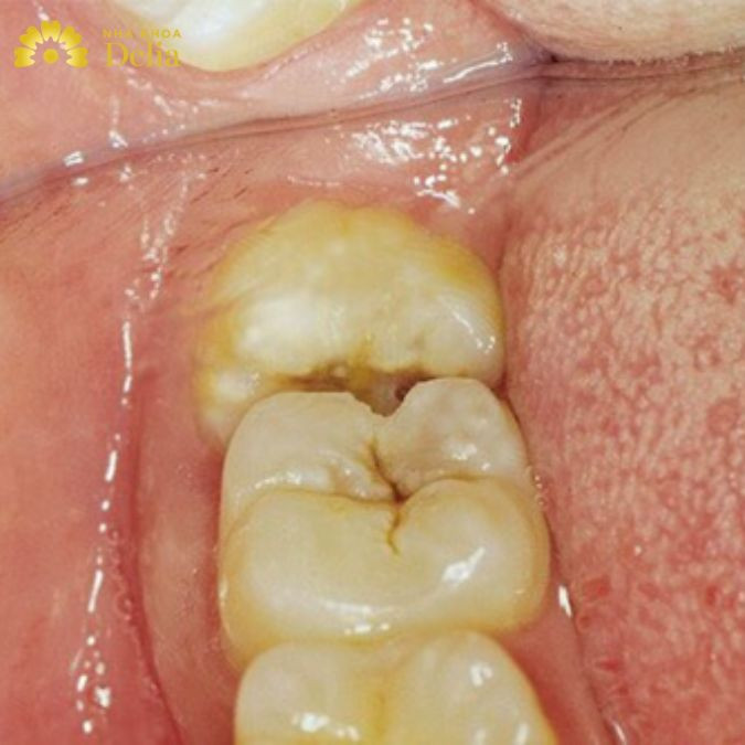 Dắt răng hay giắt răng? Giắt thức ăn ở kẽ răng cải thiện như nào?
