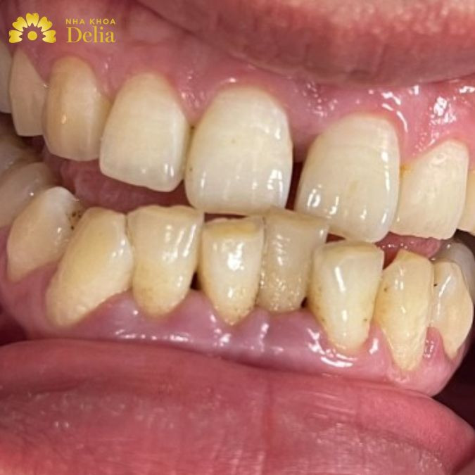 Tính thẩm mỹ bị ảnh hưởng