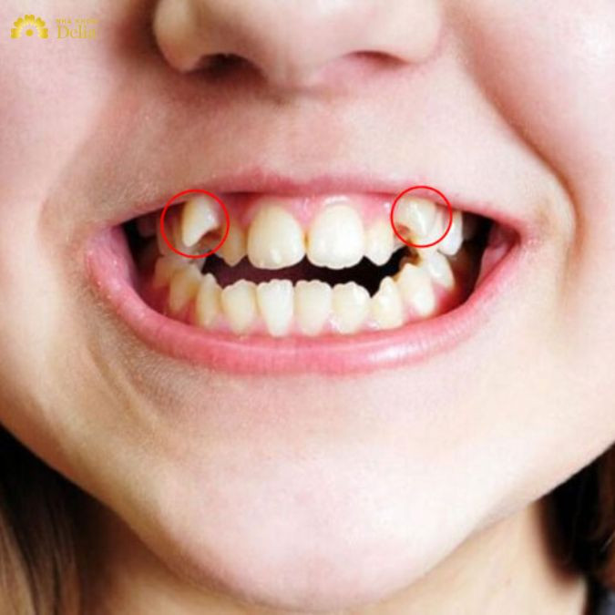 việc răng nanh thiếu chỗ trống để mọc sẽ khiến nó mọc lệch, bị chếch ra bên ngoài