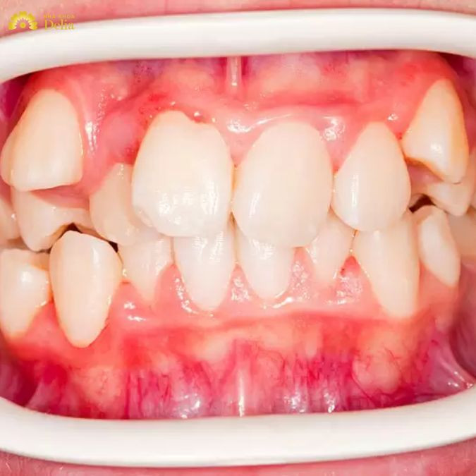 Thời điểm thay răng quá sớm hoặc răng vĩnh viễn đã mọc nhưng răng sữa chưa rụng dễ gây ra tình trạng mọc chen chúc, xô đẩy