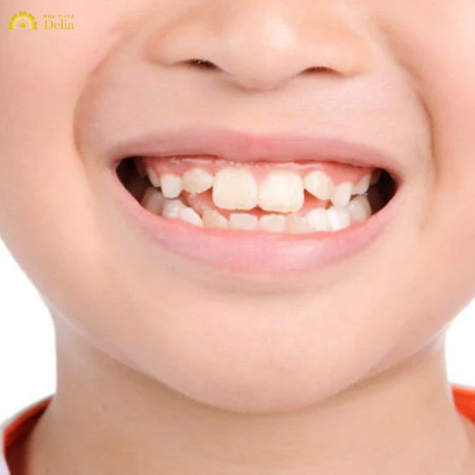 nhổ răng khểnh chỉ là một tiểu phẫu đơn giản, không mất thời gian và không quá phức tạp