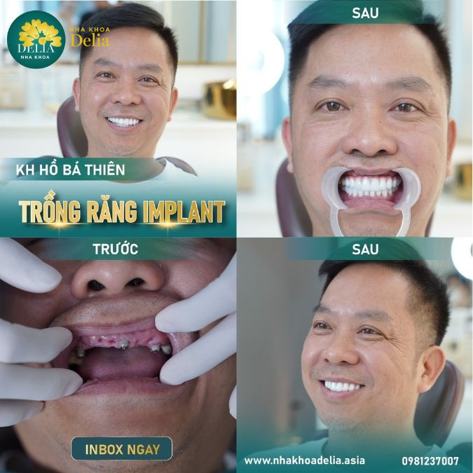 Hình ảnh răng của anh Thiên trước và sau khi qua "bàn tay phù phép" của bác sĩ Duy