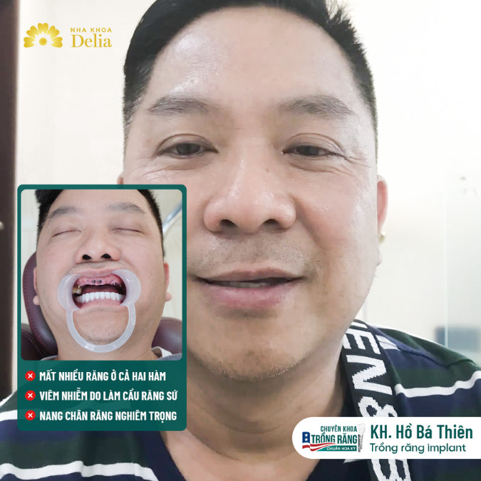 Tình trạng răng của anh Thiên: mất nhiều răng ở cả 2 hàm, viêm nhiễm do cầu răng sứ, nang chân răng