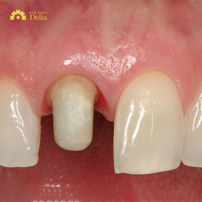 Hình ảnh răng sau khi mài để điều trị