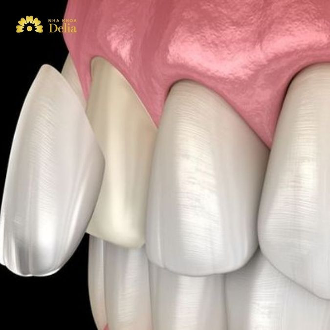 Hình ảnh răng sau khi mài để dán sứ