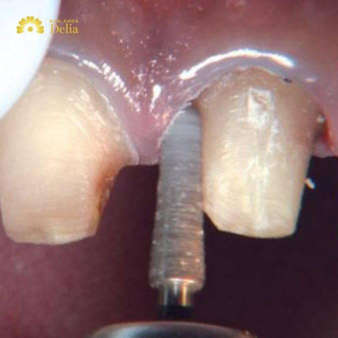 Răng đen được mài để chuẩn bị bọc sứ