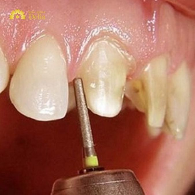 Răng được mài nhỏ để chuẩn bị điều trị