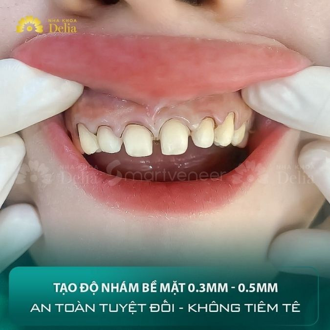 Hình ảnh răng sau khi mài chỉ 0.3 - 0.5 mm