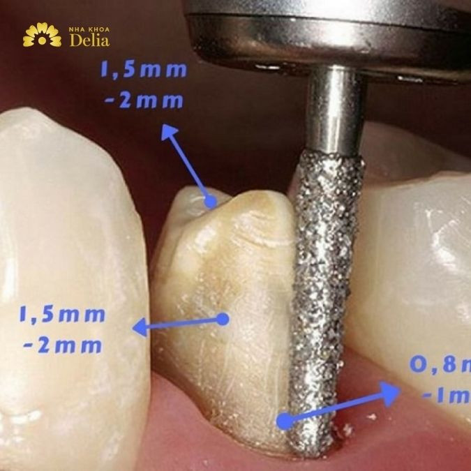 Bác sĩ tính toán để điều chỉnh mức độ mài răng phù hợp