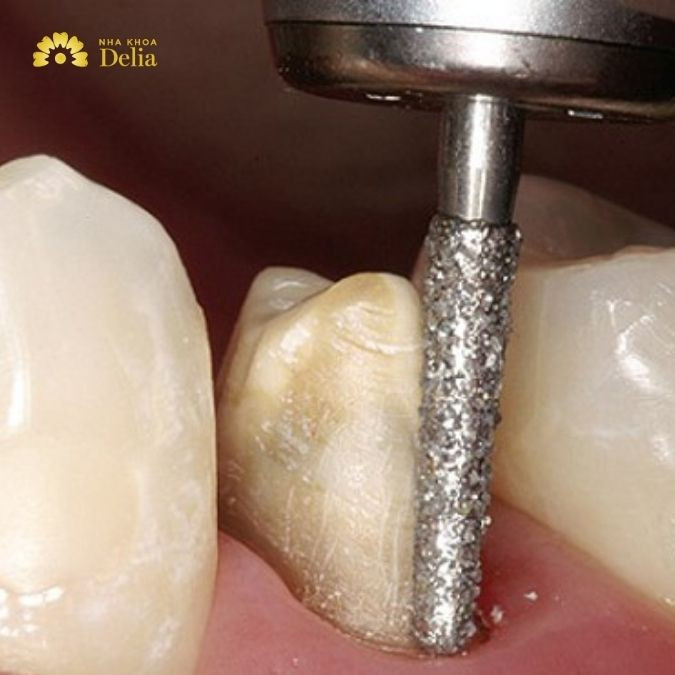 Hình ảnh mài răng trước khi bọc răng sứ