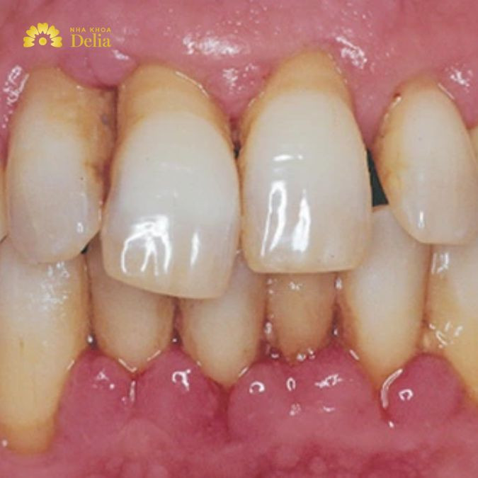 Hình ảnh viêm chân răng bị tụt lợi, hở thân răng