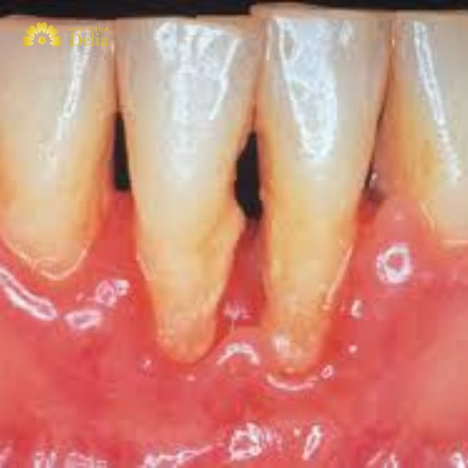 Hình ảnh mòn cổ chân răng mức độ nặng
